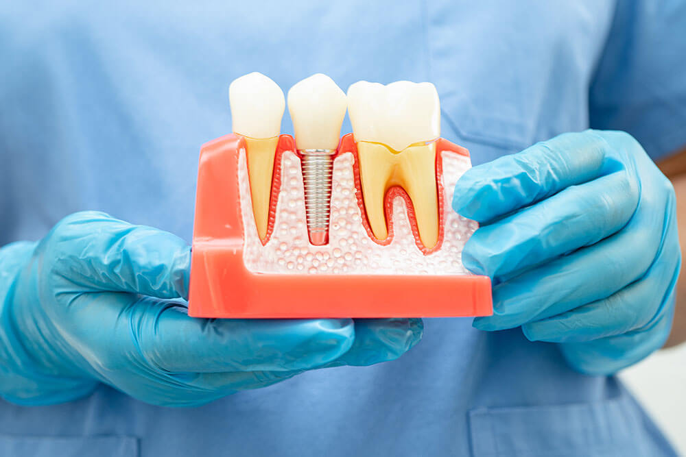 Dental Implants London